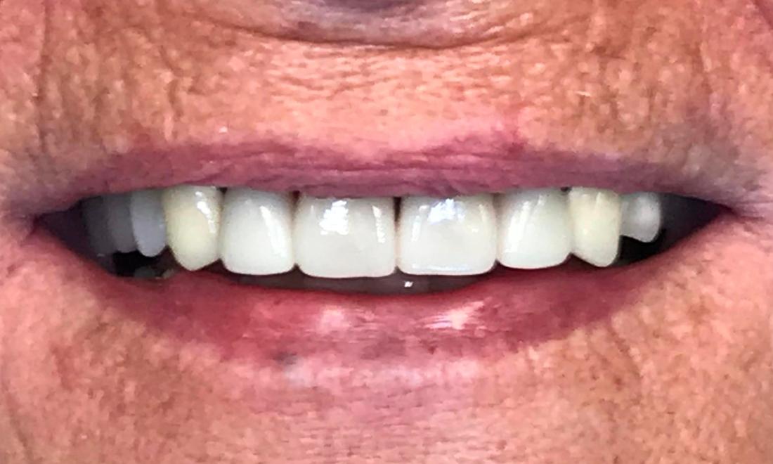 New Smile with Esthetic Crowns