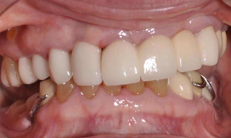 Implant-Replacing-Missing-Front-Tooth-After-Image