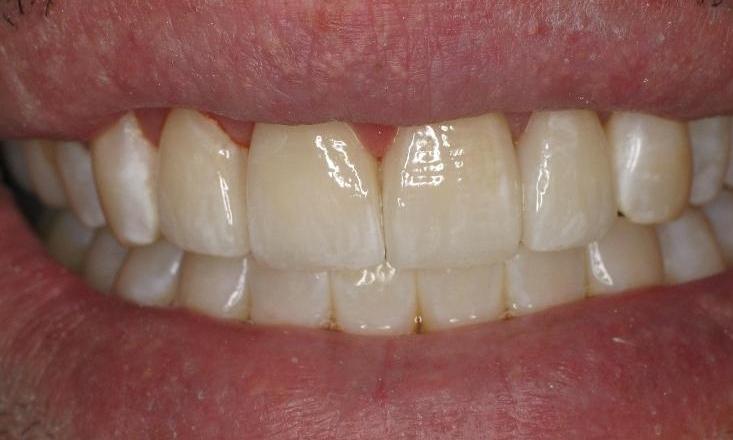 Teeth-Whitening-After-Image