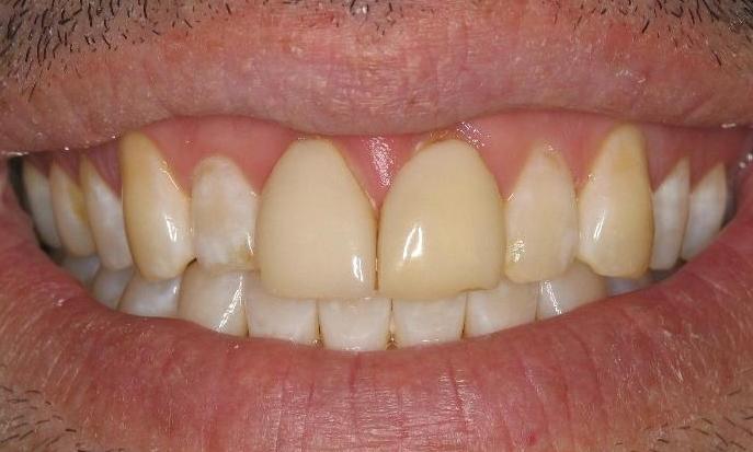 Teeth-Whitening-Before-Image